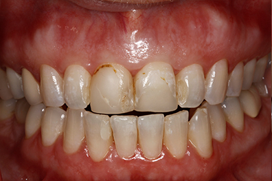Damaged and decayed top front two teeth before cosmetic dentistry