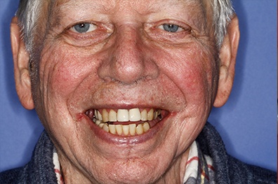 Older man with imperfect smile before cosmetic dentistry