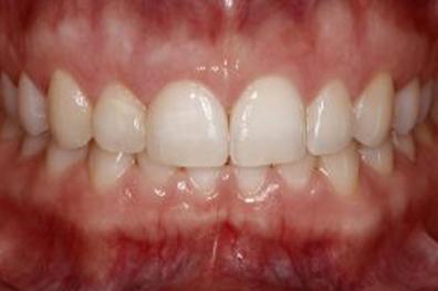 Smile enhanced with cosmetic dentistry