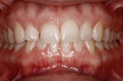 Worn and small top tooth before cosmetic dentistry