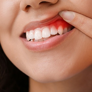 A closeup of a woman’s red and inflamed gums