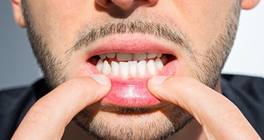 Nose-to-chin view of man pulling down lower lip to reveal underbite