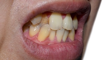 Mouth-only view of someone with a crossbite and discolored teeth