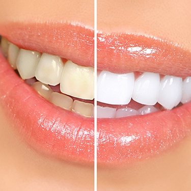  A smile that’s half white to show before/after teeth whitening comparison